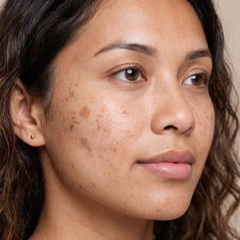 Dark Spots