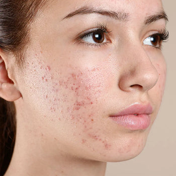Acne & Spots